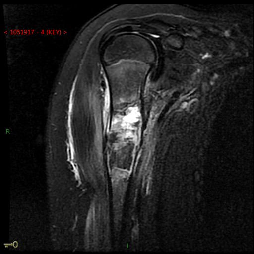 Figure 2 for case Fracture through unicameral bone cyst